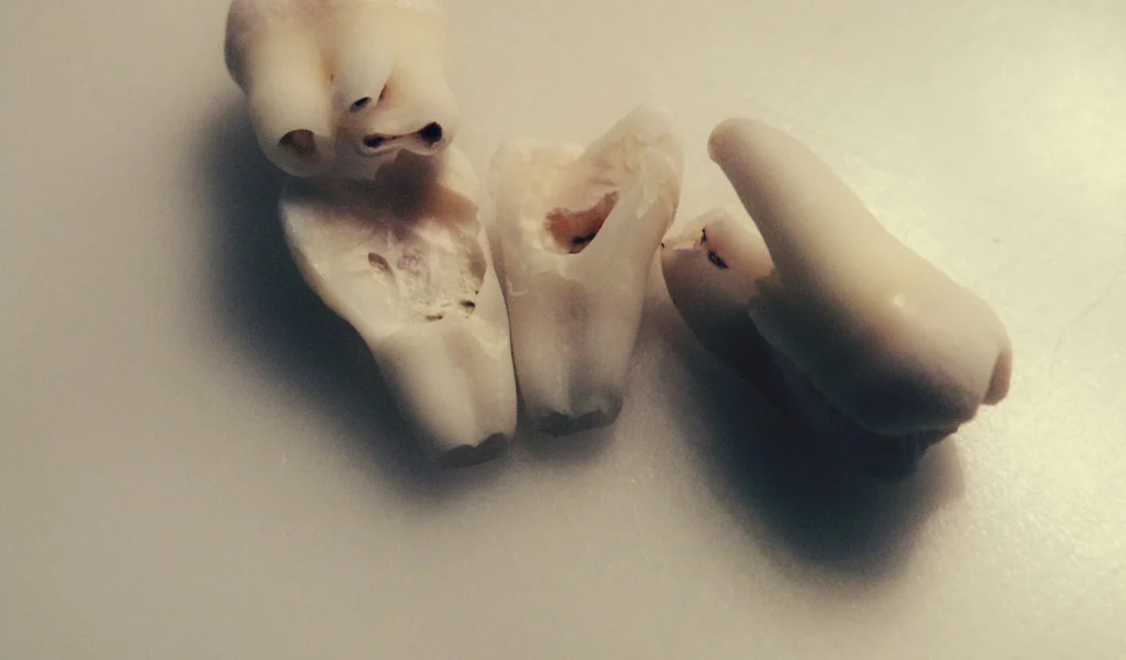 Essential Aftercare Tips for Wisdom Tooth Removal – OKC